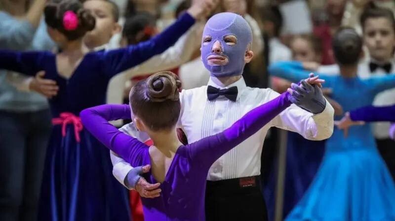 Відоме фото Романа, яке облетіло весь світ. Він із партнеркою танцює на змаганнях із бальних танців. На хлопчику спеціальна маска, яку він носив 2 роки