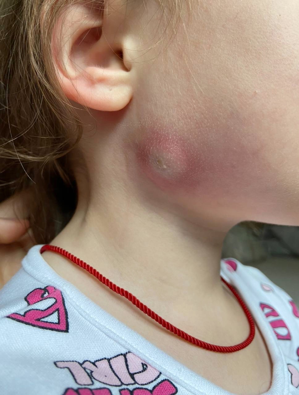 Фото 1: Могла втратити слух і навіть рухомість обличчя: львівські лікарі прооперували дівчинку, яка народилась із пухлиною