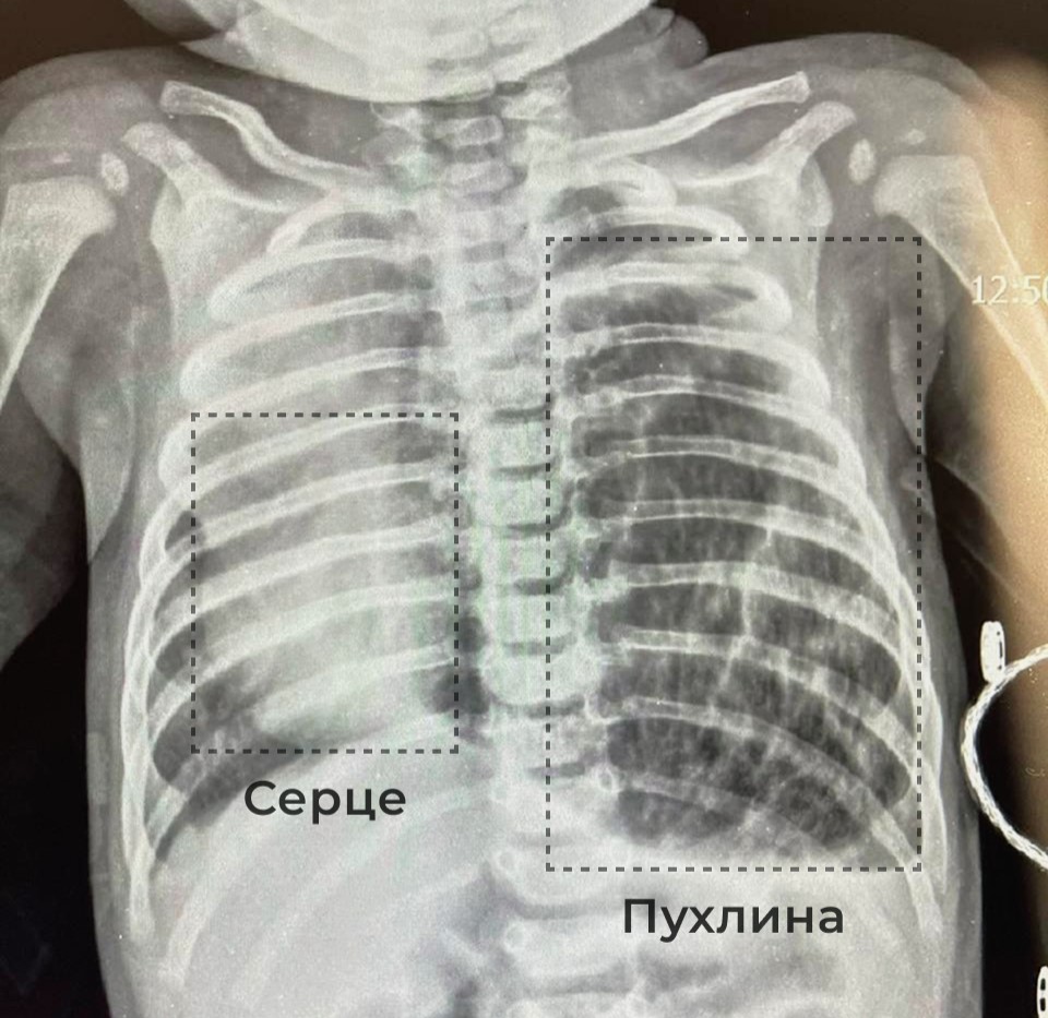Фото 1: У Львові оперують найскладніші патології: лікарі врятували немовля, яке ледь не вбила пухлина
