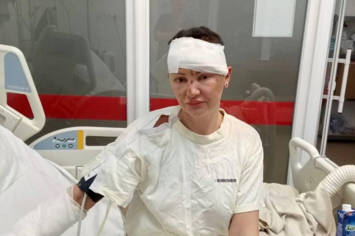 Фото 1: Львівські лікарі допомагають позбутися слідів війни одеситці, тіло якої понівечив російський шахед