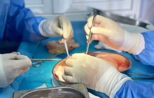 Фото 2: У Львові вперше в Україні виконали спліт-трансплантацію печінки: орган розділили на дві частини, які пересадили малюку і дорослому