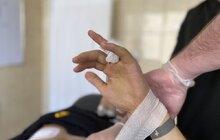 Фото 1: У Львові хірурги наново сформували палець руки з ребра
