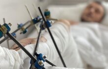 Фото 1: Львівські лікарі провели унікальну реконструктивну операцію