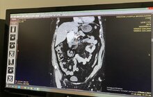 Фото 2: Львівські медики прооперували жінку з рідкісним захворюванням – аневризмою ворітної вени