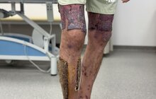 Фото 2: У Львові лікарі врятували чоловіка, який обпік 40% тіла