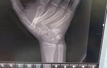 Фото 2: Медики у Львові врятували руку 17-річному хлопцю