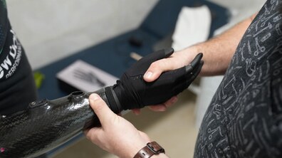 Фото: В центрі НЕЗЛАМНІ вставили 25-й біонічний протез руки: штучну кінцівку отримав 42-річний захисник