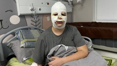 Фото: Медики застерігають: через нову пошесть із Тік-Току діти роблять «петарду» і отримують глибокі опіки обличчя